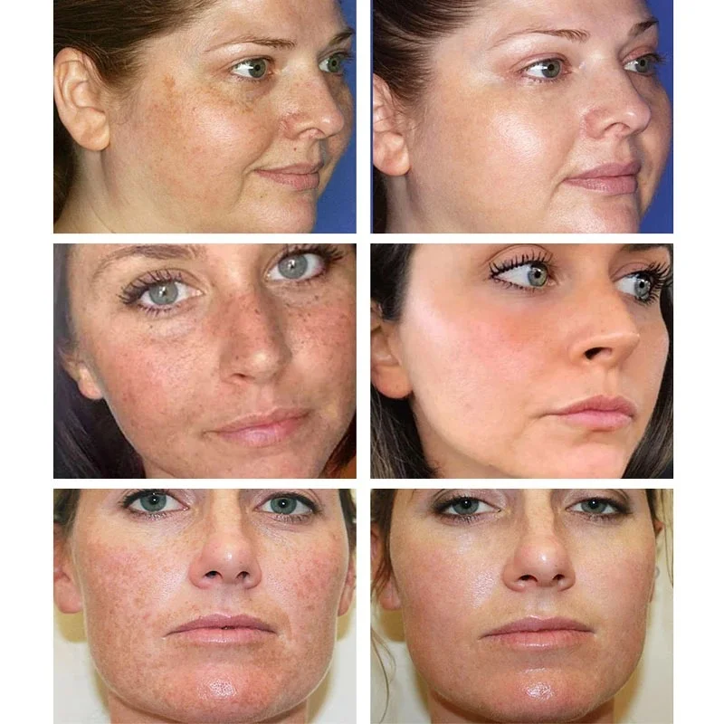 Effective Whitening Freckles C - Licorice Root Sticks recension och pris